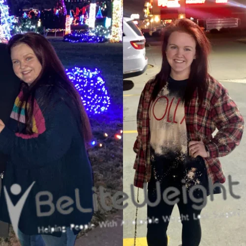 Weight Loss Surgery Gastric Sleeve before and after